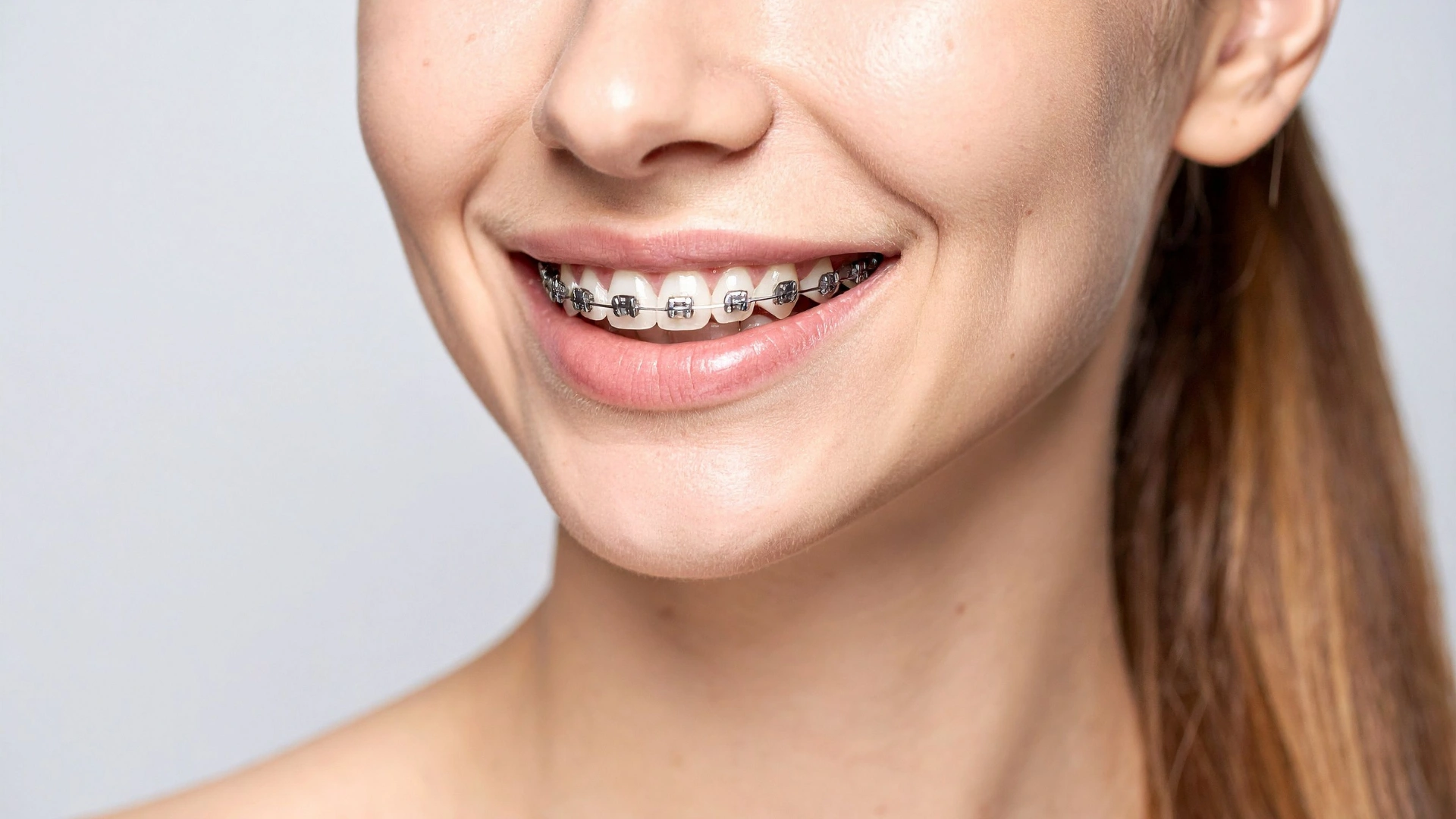 braces services