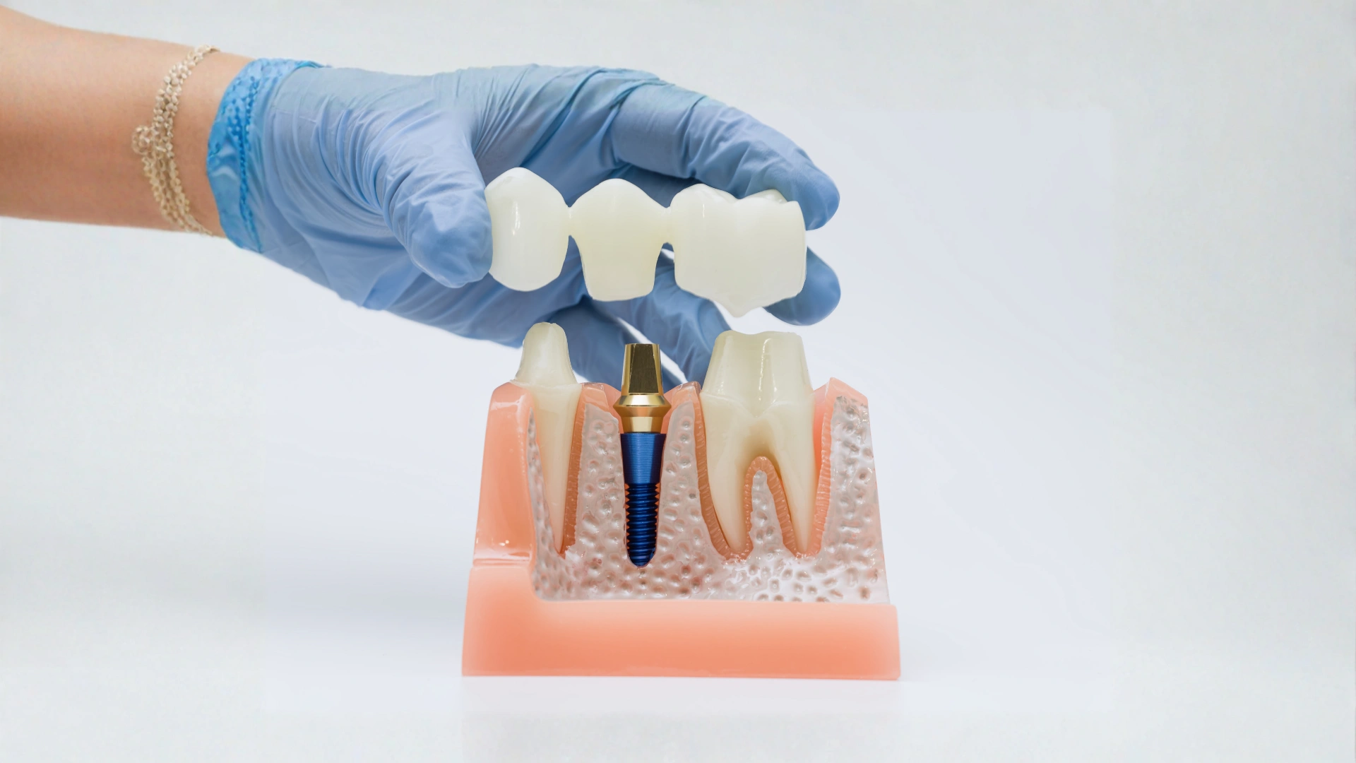 dental bridge (1)