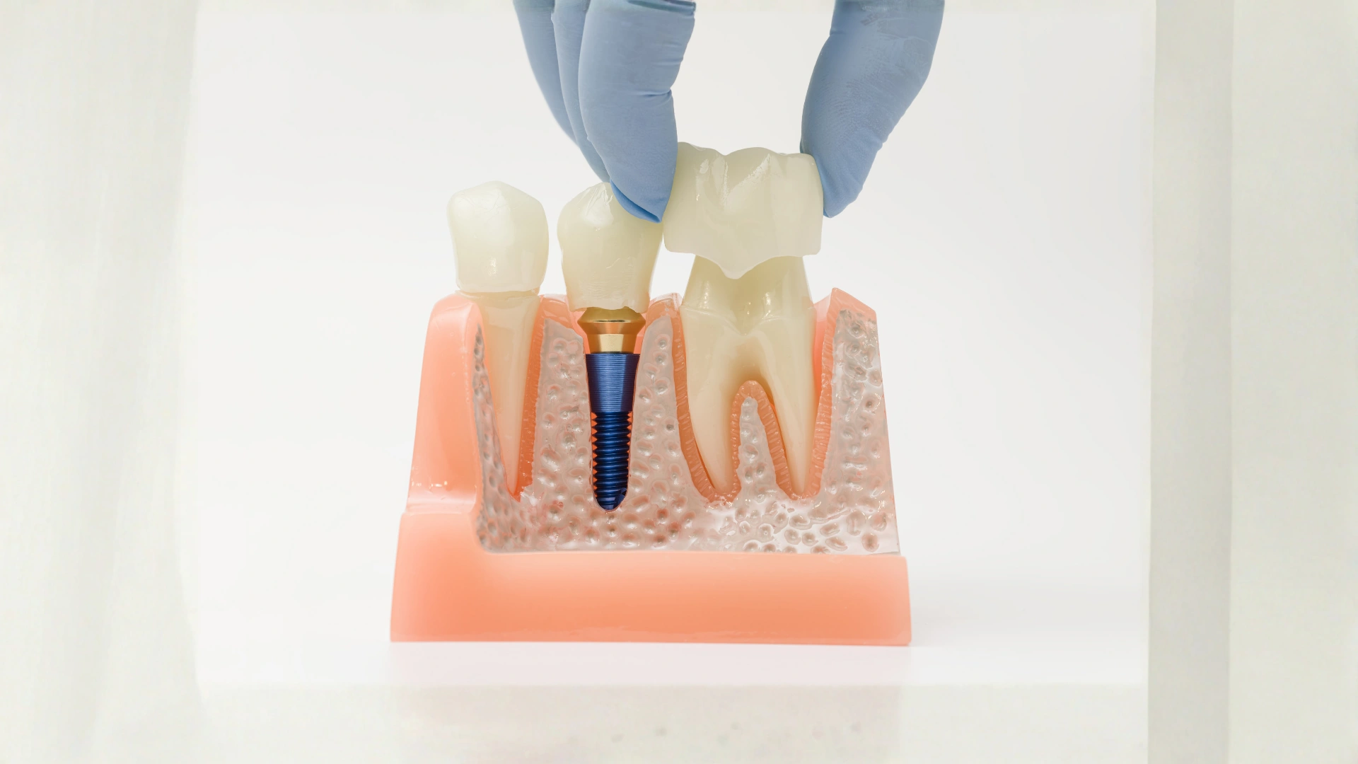 dental crown (1)