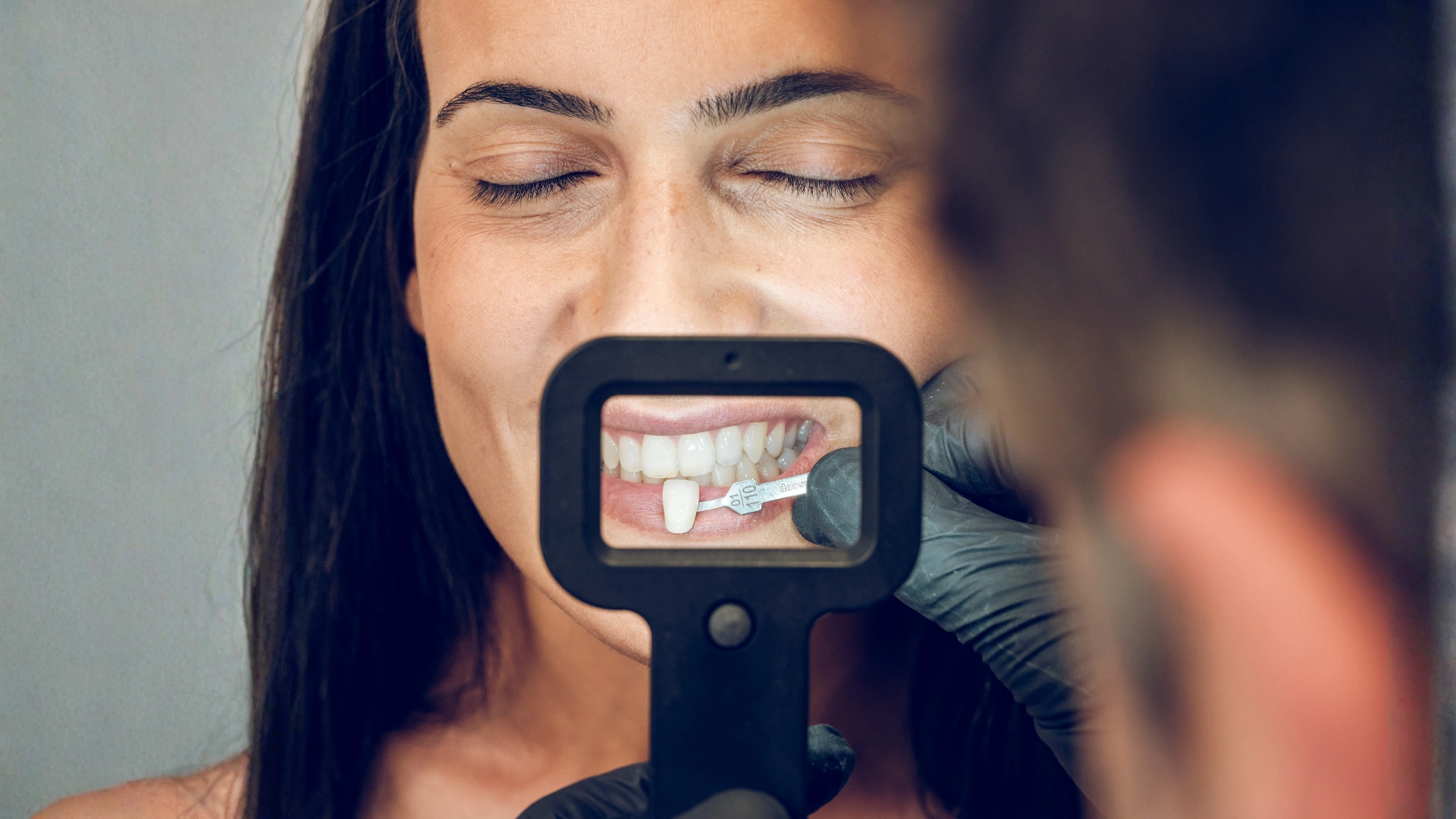 veneers service