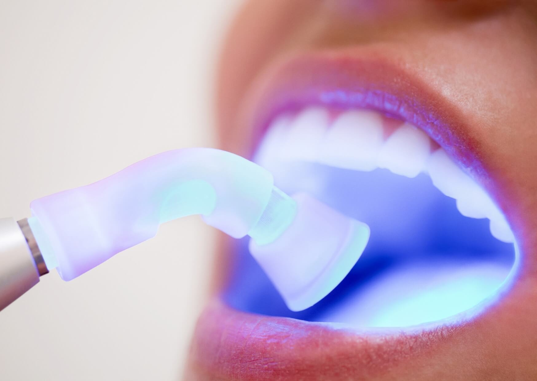 Close-up of tooth bonding material being cured with a dental light during a cosmetic bonding procedure.