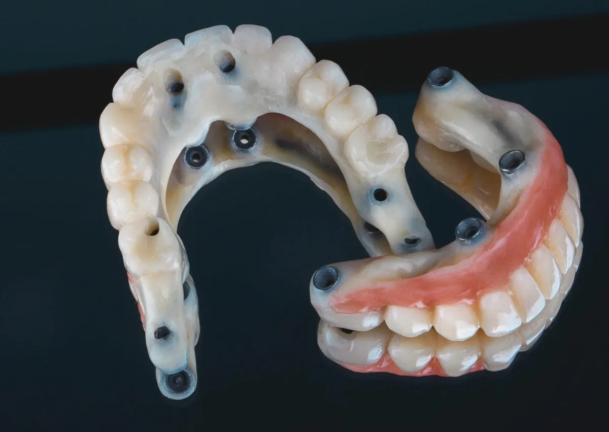 Full mouth dental implant restorations showing implant-supported teeth used to replace an entire arch.