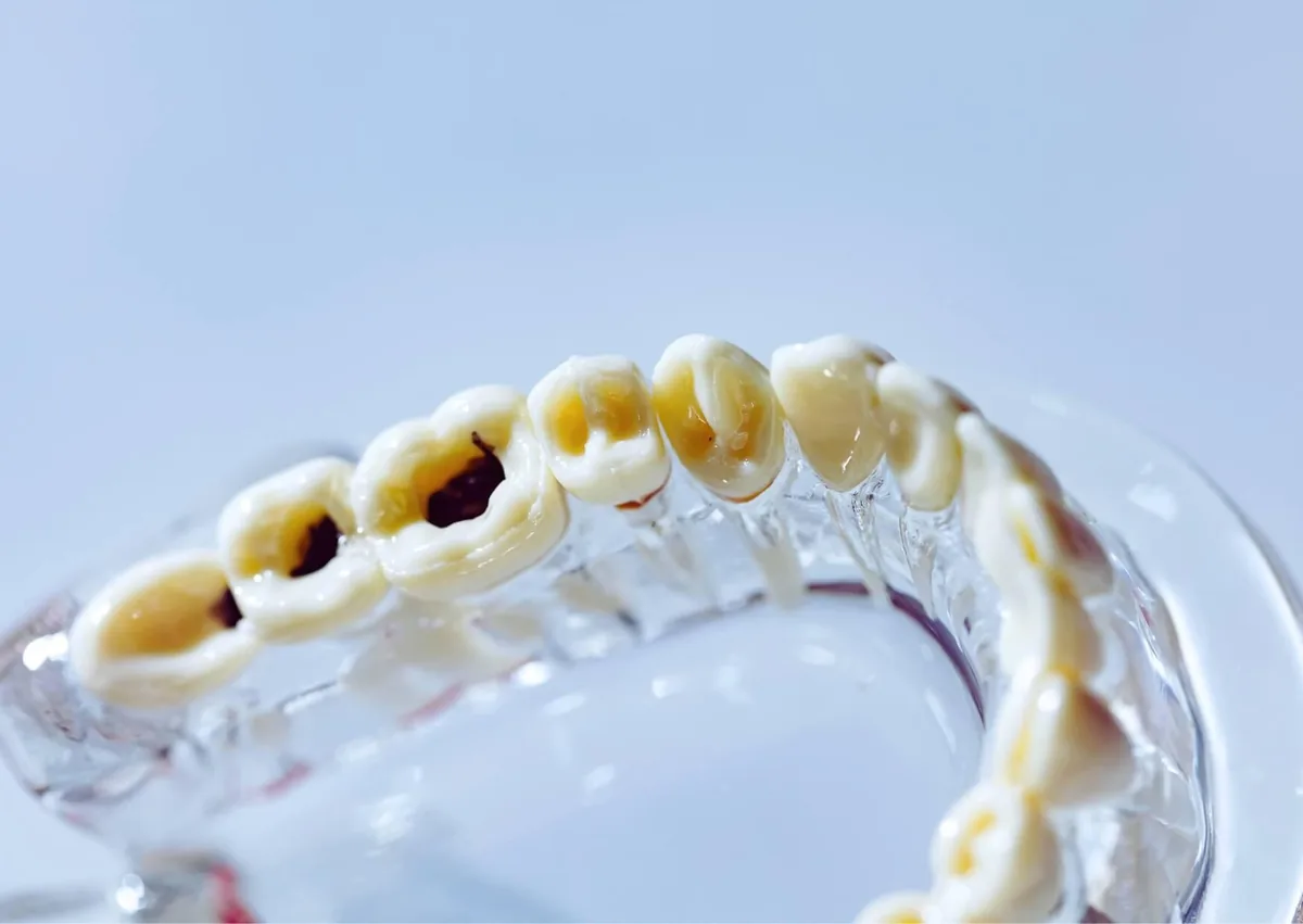 Dental model showing tooth decay and cavities to illustrate the importance of cavity prevention.