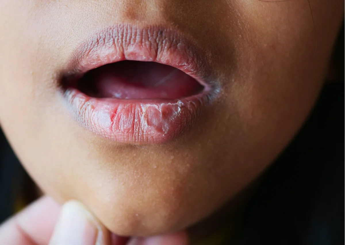 Close-up of dry, cracked lips showing a common sign of dry mouth.